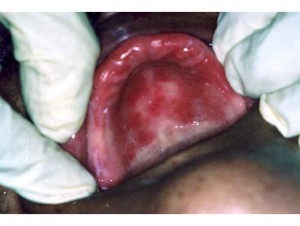 Denture-related candidiasis Â© IARC 