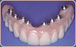 upper denture implants