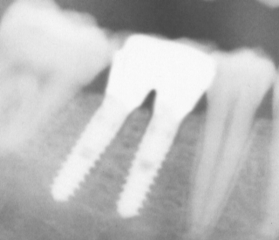 X-Ray picture of two cylindrical dental implan...