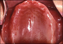 Denture Stomatitis Â© AAFP.org