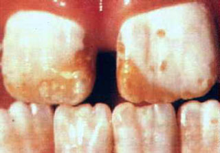 Intrinsic staining of teeth