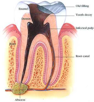 Pulp death and dental abscess.Image taken from http://www.andoverdmd.com/treatment_root_canal.html