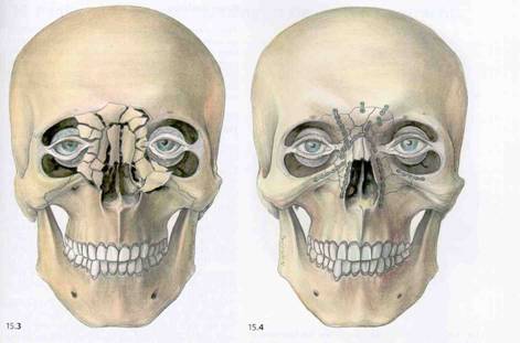 Jaw repair  Picture taken from www.biomed.metu.edu.tr/.../Bone-Plates_kayin.htm