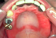 Denture stomatitis taken the shape of the denture, Picture taken from www.msi-lab.com/.../msi/images/med-symptoms.jpg