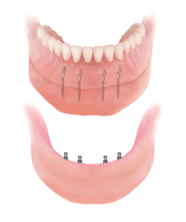Denture stabilization with mini dental implants