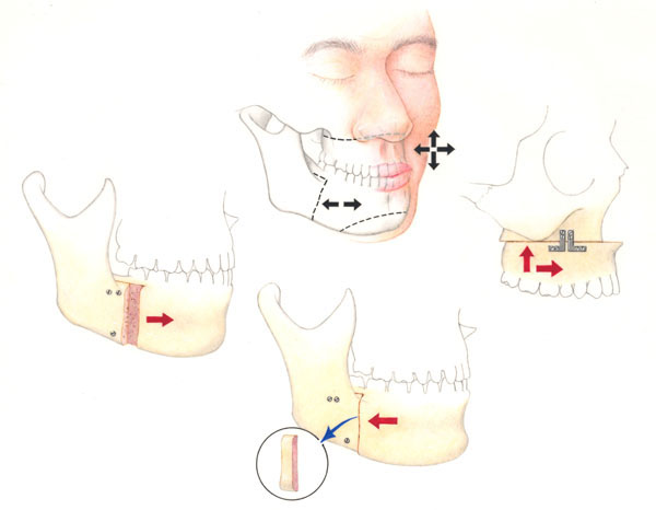 orthognathic surgery for jaw alignment  Picture taken from  www.drkaseyli.com/orthognathic.shtml