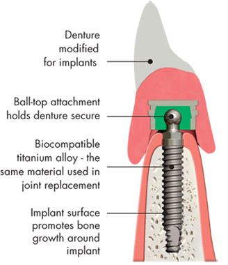 Denture implants.Image is taken from http://www.biohorizons.com/denture_stabilization.aspx