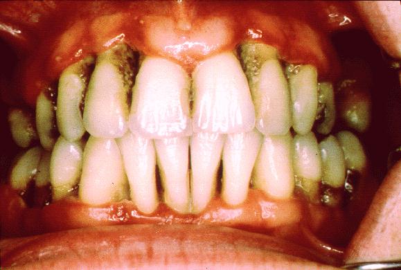 Severe periodontitis
