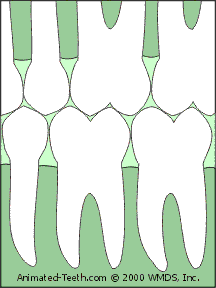 tooth shifting after extraction.image taken from http://www.animated-teeth.com/dental_crowns/t9_dental_crowns_alternatives.htm