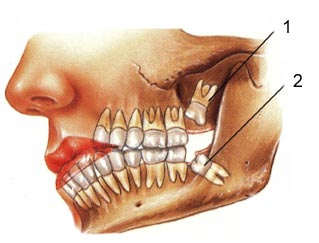 Wisdom tooth position   Picture taken from  www.lunaticgal.com/2008/07/impacted-wisdom-to...