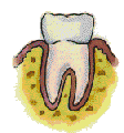 stage of gum disease.Image taken from http://users.forthnet.gr/ath/abyss/dep1251.htm