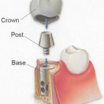 Dental implant Picture taken from bridgerdds.com