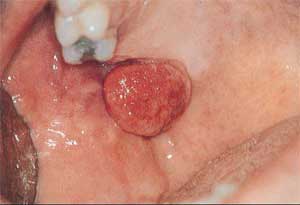 Giant Cell Tumor