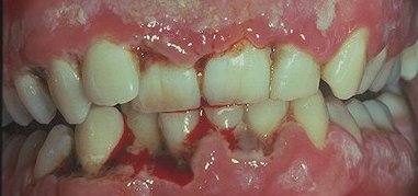 Acute necrotizing ulcerative gingivitis.Image taken from http://www.mynewsmile.com/dental/necrotizing_ulcerative_gingivitis.htm