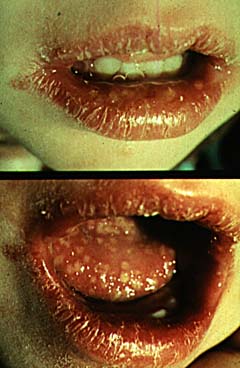 herpes gingivostomatitis.Image is taken from http://www.brown.edu/Courses/Bio_160/Projects2000/Herpes/HSV/Photos.html