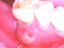 acute periodontal abscess.Image taken from http://www.dent.ucla.edu/pic/pic/members/antibiotics/abscess/abscess.html