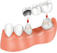 Dental bridge Â© FamilyDental101.com