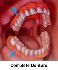 Permanent Dentures