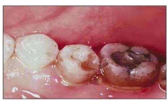 minocycline tooth discoloration