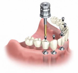 Implant supported denture Taken from idahosmilemaker.com