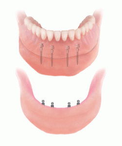 Denture stabilization with mini dental implant