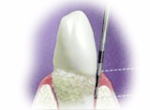 Pocket probing.Image taken from http://www.softdental.com/Houston_Dentist_Article_dental_exam_a_codiagnosis.html