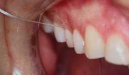 Flossing.Image taken from http://www.odontocat.com/angles/prevplacaang.htm