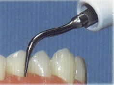 teeth scaling.Image taken from http://members.lycos.co.uk/dave_london1967/scaling1.html