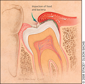 What causes nerve pain in teeth?