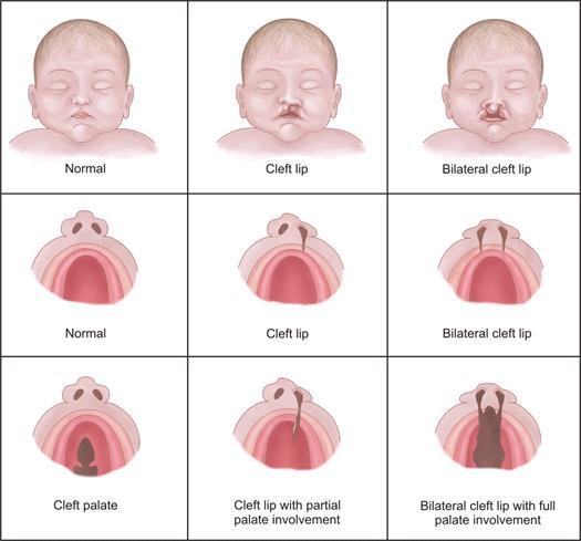 fetus   causes of cleft chin and palate