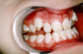 Severe fluorosis @ fluoridealert.org