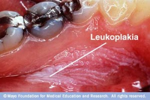 Lesion seen on the floor of the mouth