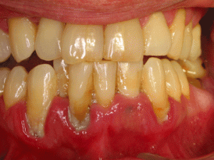 Periodontitis Â© Enom