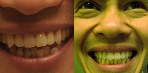 Invisible braces/Invisalign before and after shots (courtesy of reflexblue)