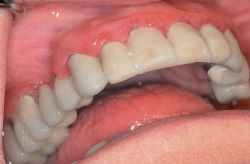 Periodontitis Â© The Free Dictionary