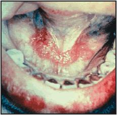 Oral cancer