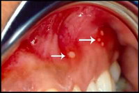 Aphthous ulcer © Kementerian Kesihatan, MALAYSIA