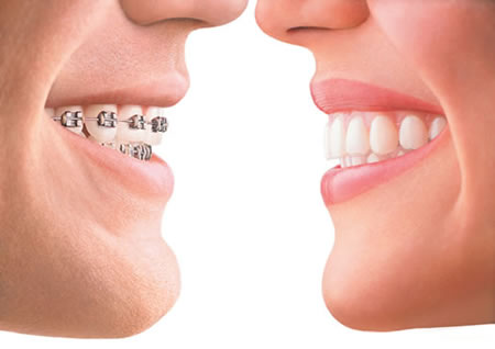 Orthodontic braces VS Invisalign