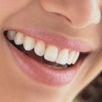Laser Teeth Whitening Smile
