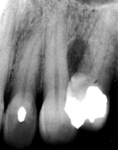 lateral periodontal cyst.Image taken from http://www.dent.ucla.edu/pic/visitors/Cysts/page2.html