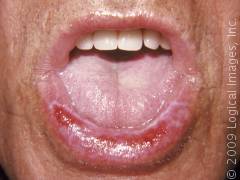 lichen planus tongue