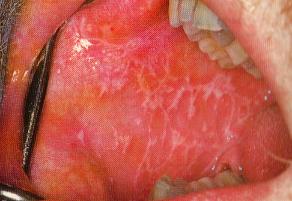 Oral Lichen Planus - AAOM