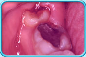 Pericoronitis © Tooth Club