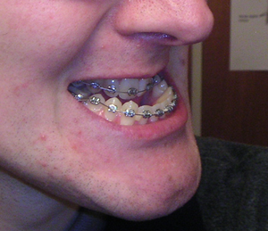 Jaw prior to surgery