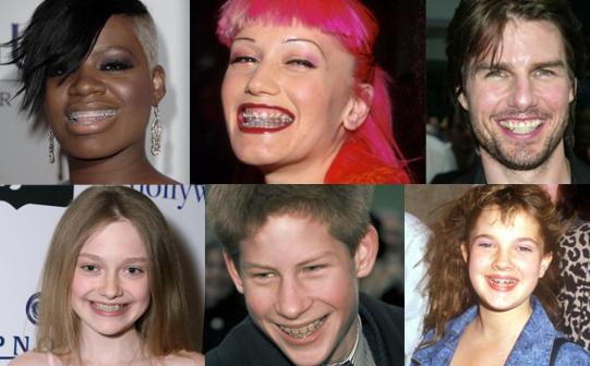 Celebrity with orthodontic braces