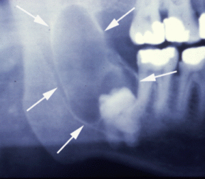 Dentigerous cyst formation from an impacted tooth