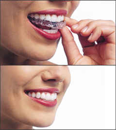 Invisible braces, Invisalign