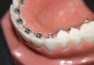 Lingual Braces