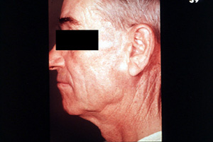 Benign parotid tumor