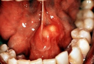 Salivary gland stone